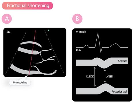 left ventricular fractional shortening